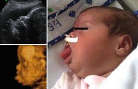 Prenatal Diagnosis Of Beckwith Wiedemann Syndrome Using 3d Ultrasound And Fetal Mri Radiology Key