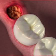 If left untreated, the infection will spread to the tips of your tooth roots. Blood Clot Wisdom Tooth Novocom Top