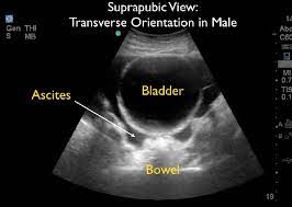 Who says you can only create photos to prank your loved ones? Suprapubic Ultrasound View With Free Fluid Download Scientific Diagram
