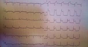Astfel de tulburări în compoziţia de 4,5% apar la persoanele în vârstă după 40 de ani. Protocolul Infarctului Miocardic Mednet24