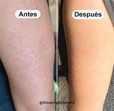 Si quieres tratar queratosis pilaris, esto es lo que necesitas saber: ☑️La  queratosis pilaris es una afección de la piel común e inofensiva que puede  causar parches secos y ásperos y pequeñas