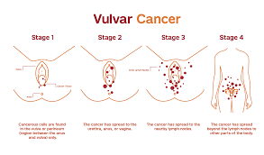 The signs and symptoms of cancer depend on the type of cancer, where it's located, how advanced it is, and how much it has spread. Vulvar Cancer Patient Care