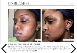 Adolescent acne affects 80% of people between 12- 24 years of age whereas  adult acne occurs in 45% of women over the age of 25! You can spot the  difference based on