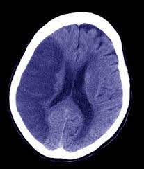 Check spelling or type a new query. Las Claves Para Mejorar El Pronostico De Los Enfermos Con Trombosis Cerebral Elmundo Es Salud