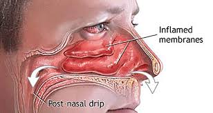 Diy How To Clear Your Sinuses In Seconds Using Nothing But Your Fingers Health Bea Remedy For Sinus Congestion Sinus Infection Remedies Stuffy Nose Remedy