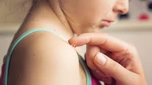 Image result for shingles in children