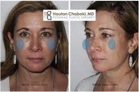 Anything else 'healthy' you shouldn't do after fillers? Cheek Augmentation With Fillers