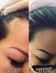 Feeling Excited April 14 2017 My Receding Hairline Is Growing Hair Let It Grow System An Receding Hair Styles Regrow Hairline Hair Fall Solution