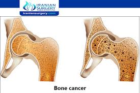 Bone tumors can be of two different types. Bone Cancer Causes Bone Cancer Causes And Symptoms Iranian Surgery