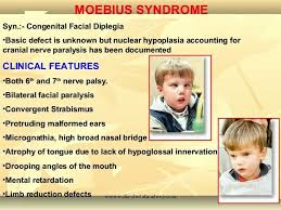 Nord gratefully acknowledges john b. Moebius Syndrome 6th 7th N Palsy Convergent Strabismus Micrognathia Nerve Palsy Medical Information Syndrome