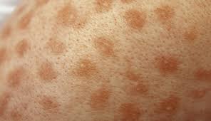 Image result for Urticaria pigmentosa children