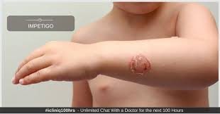 Image result for Impetigo