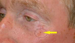 If breast cancer is diagnosed at an early enough stage, it's treatable. Skin Cancer Treatment Chicago Il Skokie Northbrook Waukegan