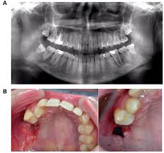Image result for Alveolitis sicca)