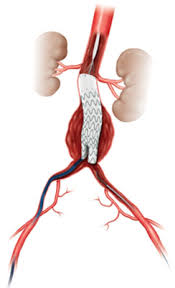 Un aneurisma aortico addominale si ha quando i grandi vasi sanguigni che forniscono di sangue l'addome, il bacino e le gambe diventano eccessivamente grandi o si rigonfiano verso cause: Cirugia Minimamente Invasiva Para Tratar El Aneurisma Aortico Abdominal De Dificil Acceso Hospital Clinic Barcelona