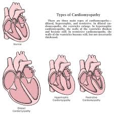 Image result for Cardiomyopathy
