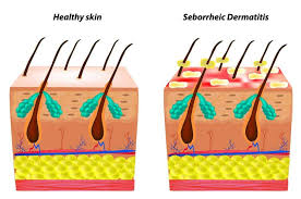 Looking for the best shampoo to solve your dry scalp problem? 8 Best Seborrheic Dermatitis Shampoos That Work 2021