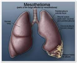 When it comes to monitoring your health, your heart and lungs are right at the top of the list of important organs you should focus on. Lung Sparing Treatment Options For Malignant Pleural Mesothelioma Fox Chase Cancer Center Philadelphia Pa