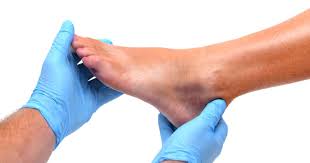 A bunion develops when the bones in the joint on the outer side of the big or little toe become misaligned, forming a painful swelling. Foot Bruise