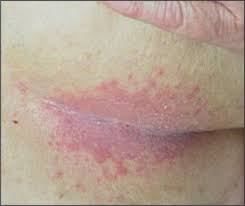 Intertrigo is a rash that usually affects the folds of the skin, where the skin rubs together or where it is often moist. Pin On Health