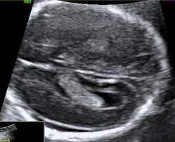 Soft Markers Fetal Ultrasound