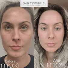 Moxi Laser Treatments