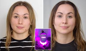 London Woman Tests Out Light Therapy Mask To Treat Acne Daily Mail Online