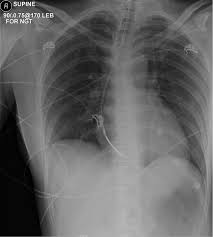 Image result for Chest XRay Interpretation