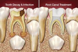 Root Canal Treatment On Baby Teeth News Dentagama