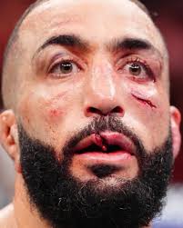 UFC fighter undergoes facial surgery after injury