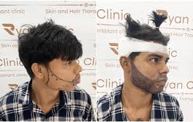 Best Hair Transplant in India