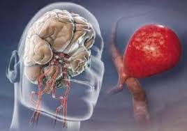 Un aneurisma cerebral es una enfermedad cerebrovascular que puede provocar hemorragia en el cerebro. Aneurisma Cerebral Neuro Spine De Nayarit