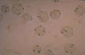 Image result for G6PD Deficiency Detection