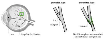 Gefassverschlusseǀ Augenklinik Dardenne