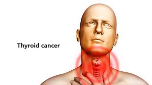 Papillary (the most common type) Thyroid Cancer Symptoms Causes And Treatment Medlife Blog Health And Wellness Tips