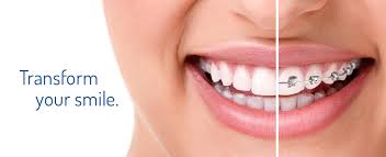 Image result for orthodontic treatments available