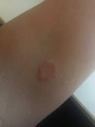 Ist Das Hautpilz Unterarm Gesundheit Und Medizin Medizin