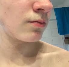 Damit krusten schneller abheilen, sollten sie diese nicht abkratzen. Warum Ist Meine Nase Immer Rot Entzundet Nasenflugel Gesundheit Und Medizin Gesundheit Haut