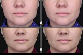 Prospective clinical study and ultrasound assessment in patients with  bruxism treated with botulinum toxin