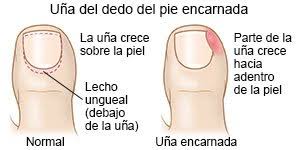 Que procede o juzga con parcialidad, sin ecuanimidad. Avulsion Parcial De La Una Care Guide Information En Espanol