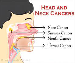 If your doctor thinks you have a problem with your nasopharynx, they'll do a detailed exam of your head and neck. Quiz On Head And Neck Cancer