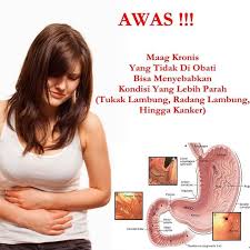 Bahaya maag kronis perlu diwaspadai karena bisa sebabkan penyakit ini. Obat Maag Kronis Herbal Tanpa Operasi Home Facebook