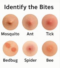 Image result for ant bite
