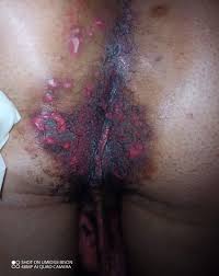 HOYMAS clinic visit 1, inflamed anal region (June 13, 2023; Photo... |  Download Scientific Diagram