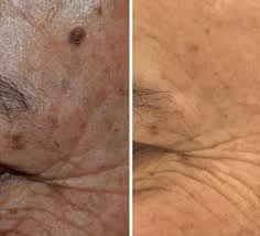 Luminiix - Elimina verrugas rápido y sin dolor – Merkania