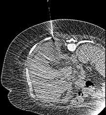 Urinary Tract Infection Caused By Citrobacter Koseri In A Patient With Spina Bifida An Ileal Conduit And Renal Caluli Progressing To Peri Nephric Abscess And Empyema Sciencedirect