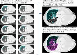 For many years, radiation therapy was delivered after extrapleural pneumonectomy with acceptable results. Functional Image Guided Radiation Therapy Planning In Volumetric Modulated Arc Therapy For Patients With Malignant Pleural Mesothelioma Advances In Radiation Oncology