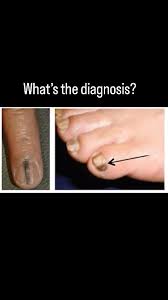 Image result for Acral lentiginous melanoma nail