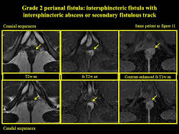 Image result for Intersphincteric Abscess
