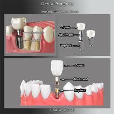 We did not find results for: Dentist Nyc Dental Crowns Nyc Sachar Dental Nyc